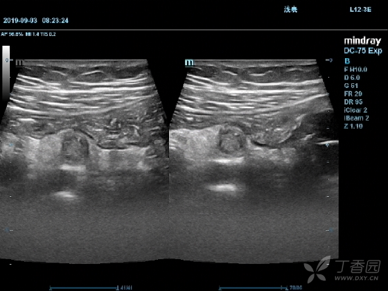 急性阑尾炎是突然形成的吗 3366718711116688231-8w.bmp