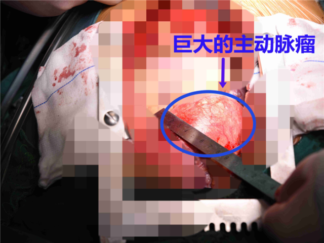 男子两周内脑梗两次 祸首竟是血管「鼓包」了