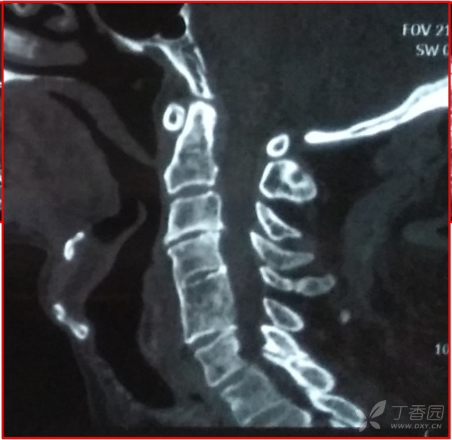 什么情况才算是脊髓型颈椎病 3367268488405815558-8w.jpg
