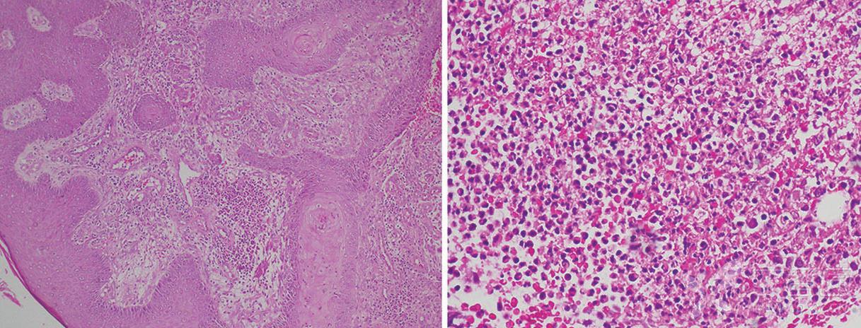 100)(c);真皮中性白細胞增多且微膿腫伴嗜酸性粒細胞增多(he染色