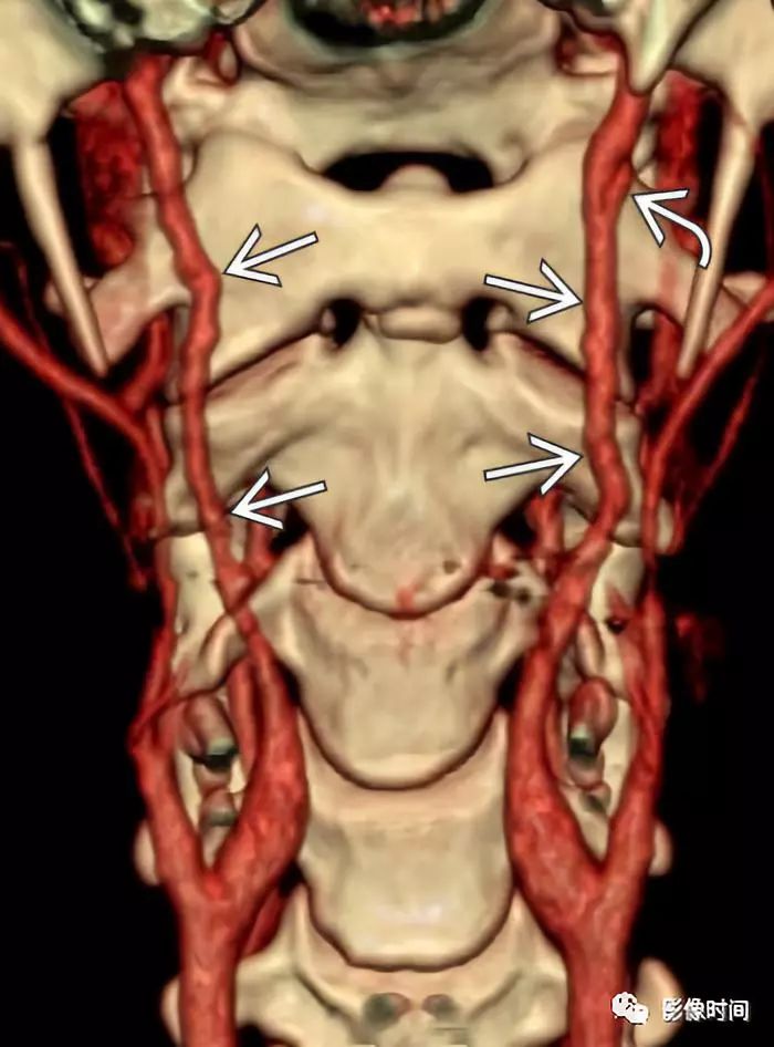 颈横血管解剖图CT图片