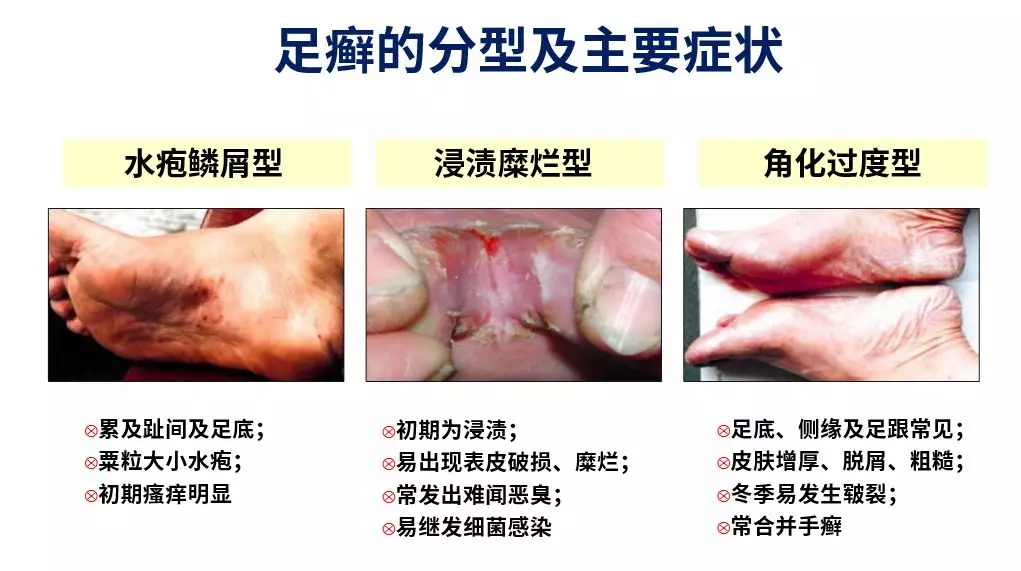 对抗皮肤病实用技巧 李厚敏教授 浅谈手 足癣的诊治策略 皮肤性病 丁香园论坛