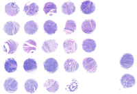 子宫内膜癌组织芯片 F261201