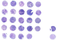 肝癌组织芯片D260601