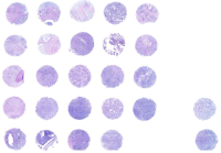 胰腺癌组织芯片 D260701