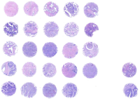 宫颈癌组织芯片 F261301