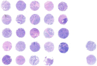 前列腺癌组织芯片 M261601