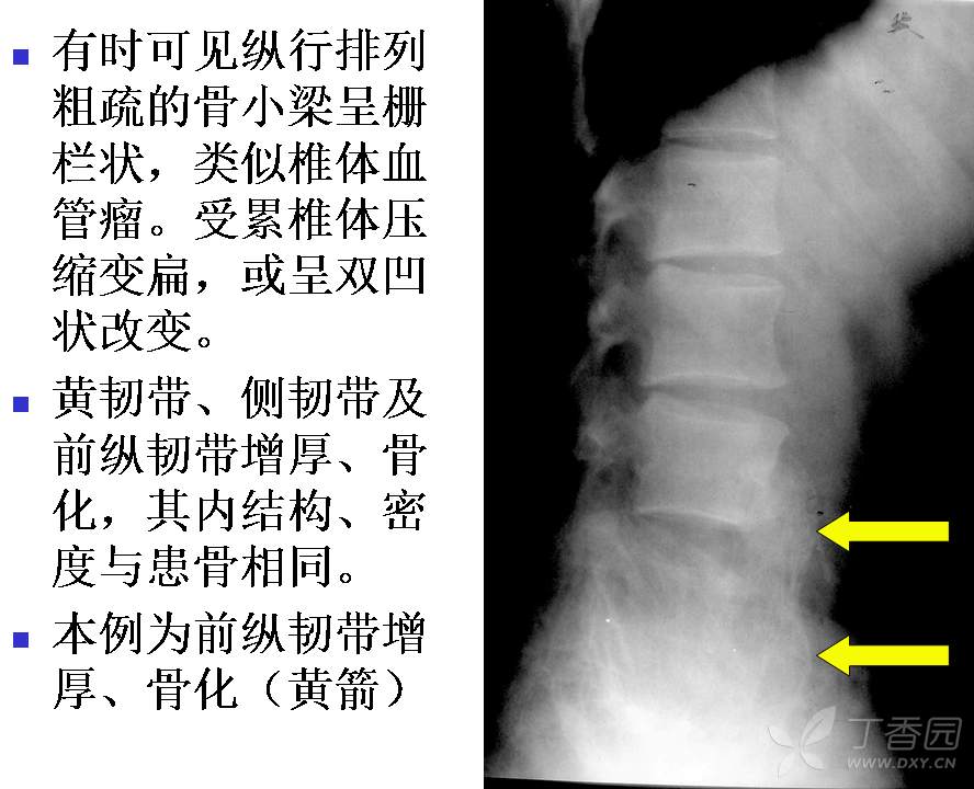 畸形性骨炎图片