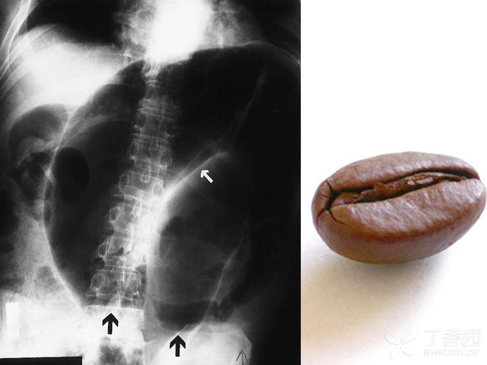 腹痛拍个片,鸟嘴咖啡豆