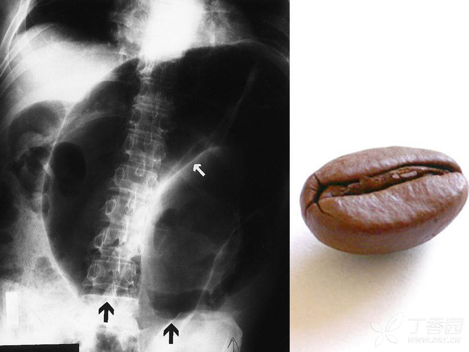 肠梗阻咖啡豆征图片图片