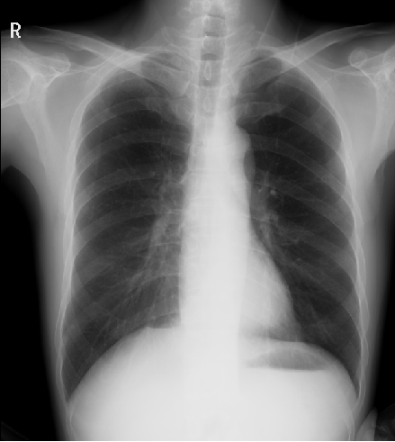 图2 多功能动态DR的尘肺检查.png