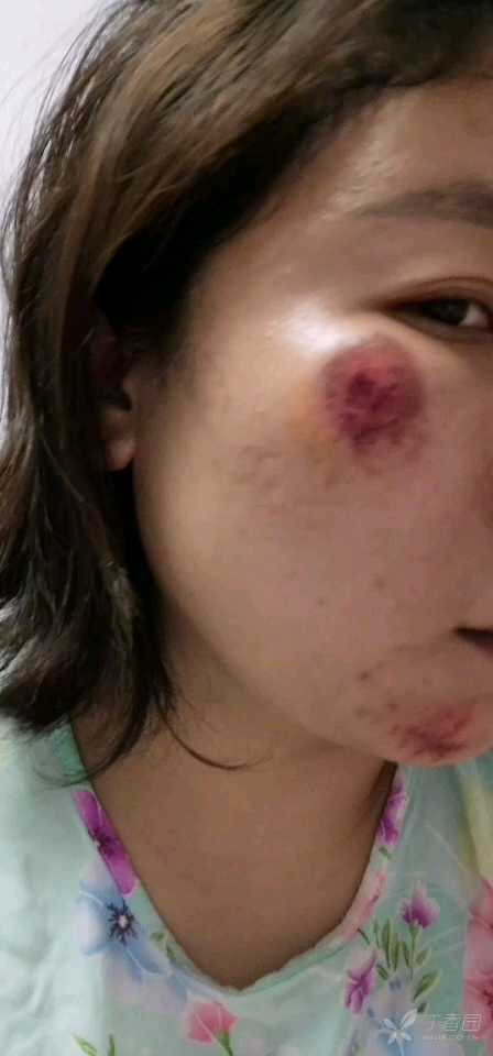 面部擦伤怎样处理不落疤 - 丁香园论坛