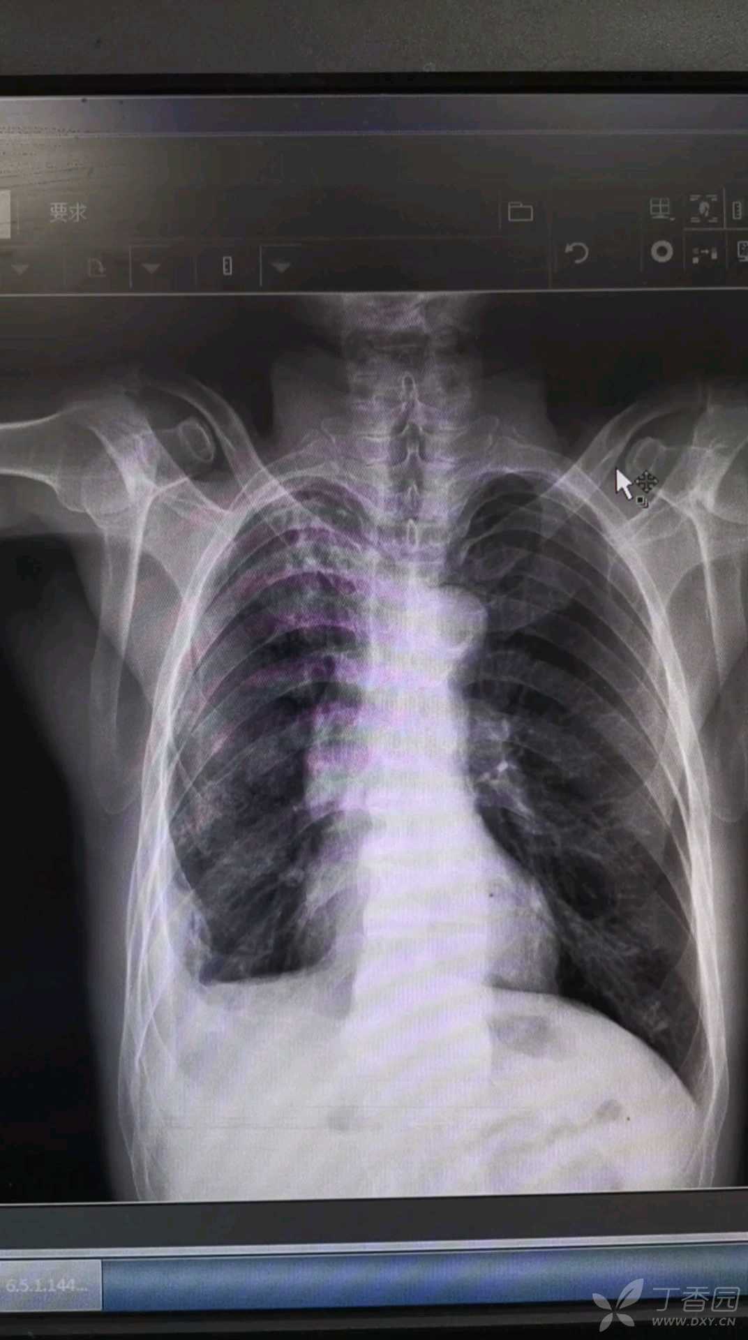 原发性肺结核x线图片