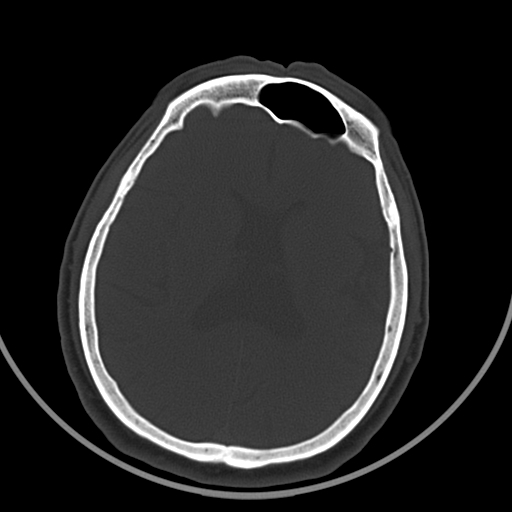脑裂畸形伴透明隔缺如