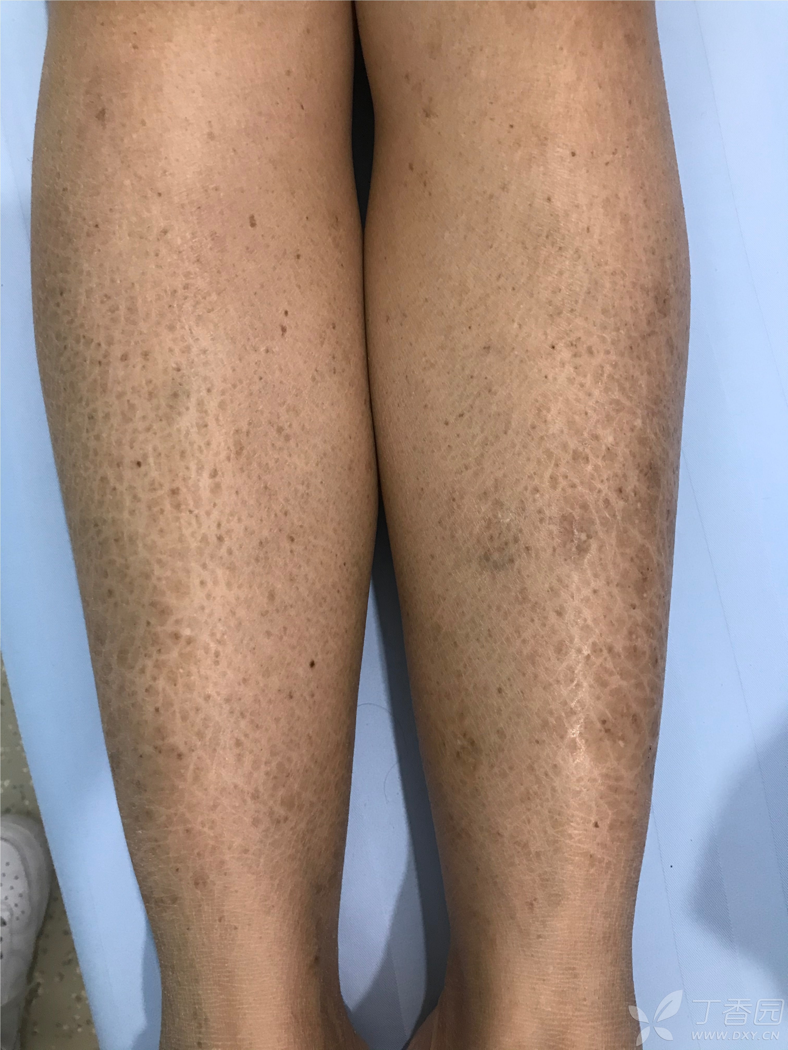 两母女的皮肤异常 [病例帖]