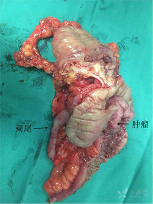 2,此次切除阑尾最大的顾虑是回盲部有其他病变,切除阑尾后引起粪瘘
