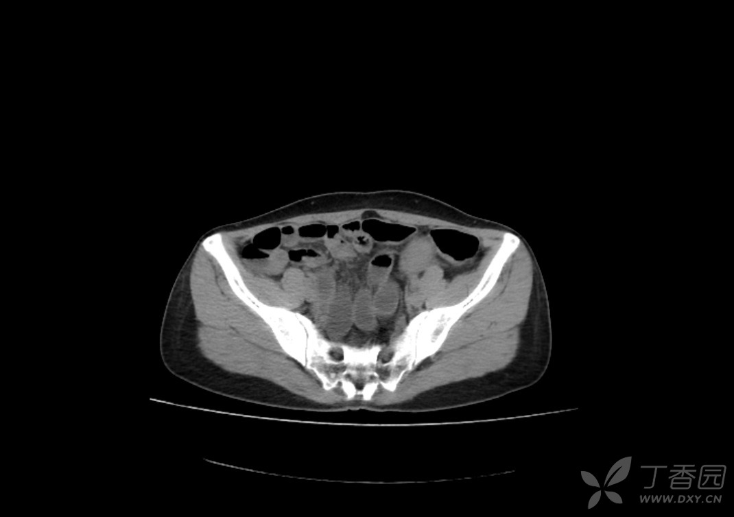 盆腔占位伴腹膜后明显强化淋巴结,求会诊. [病例帖]