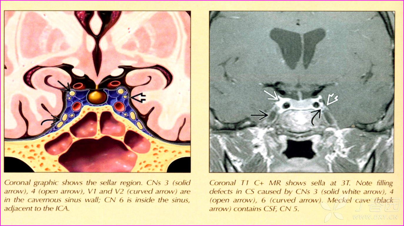 垂体腺瘤影像学表现及鉴别诊断 - 影像医学和核医学讨论版 -丁香园论坛