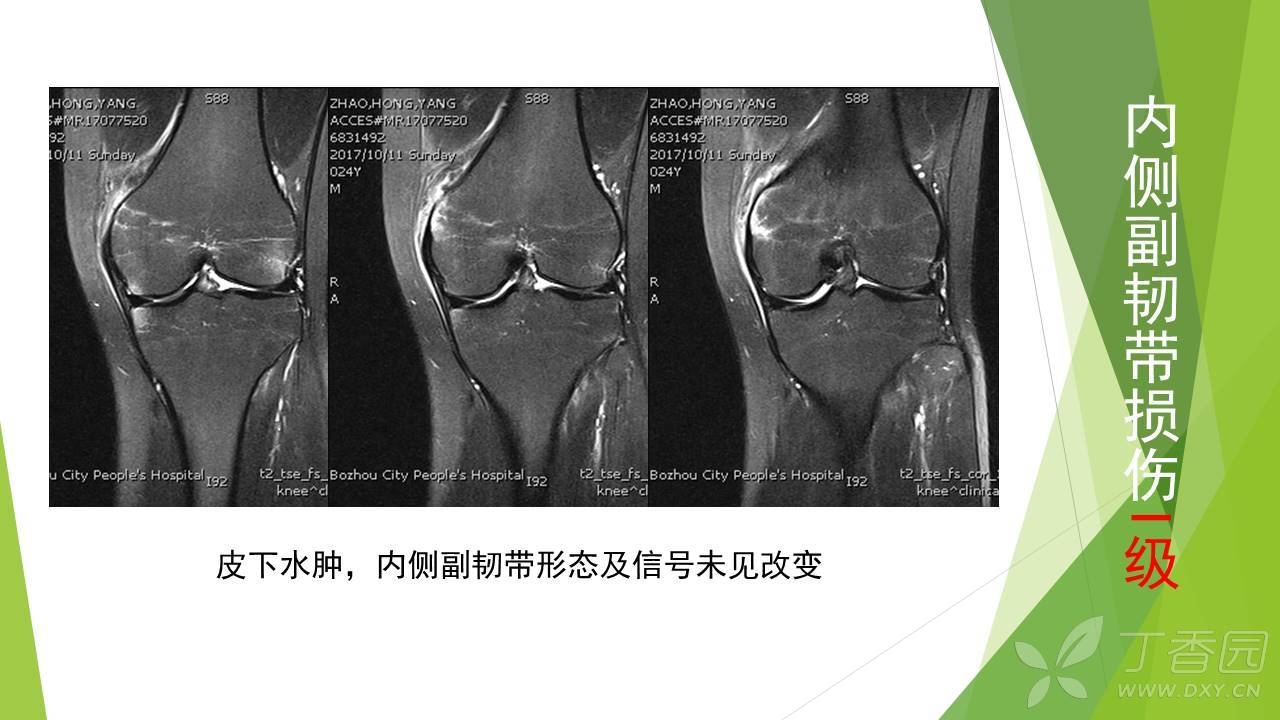 膝关节韧带能自愈吗 膝关节韧带图