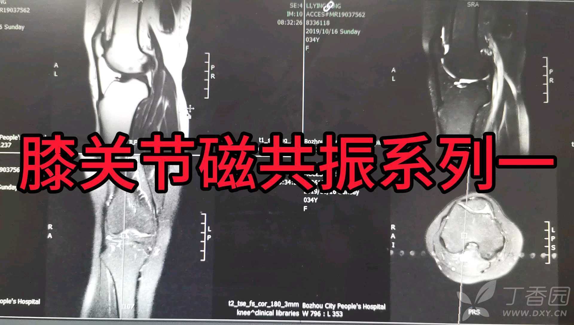 简介膝关节软组织运动损伤类型和案例分析 - 知乎