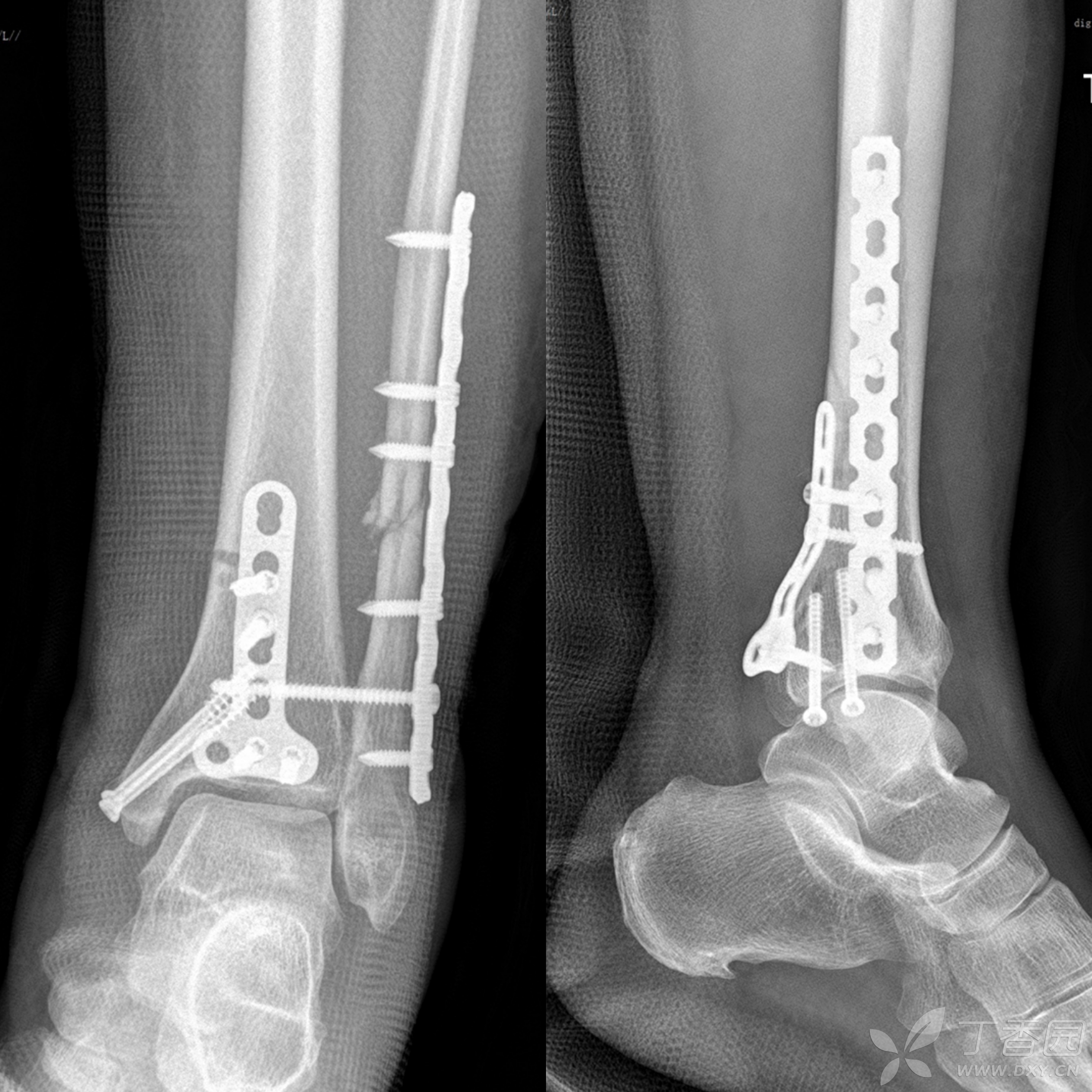 三周前，我从高处跳下，伤到了脚踝，请大家帮我看看X光片，看是哪里骨折了？需怎么治疗？_百度知道