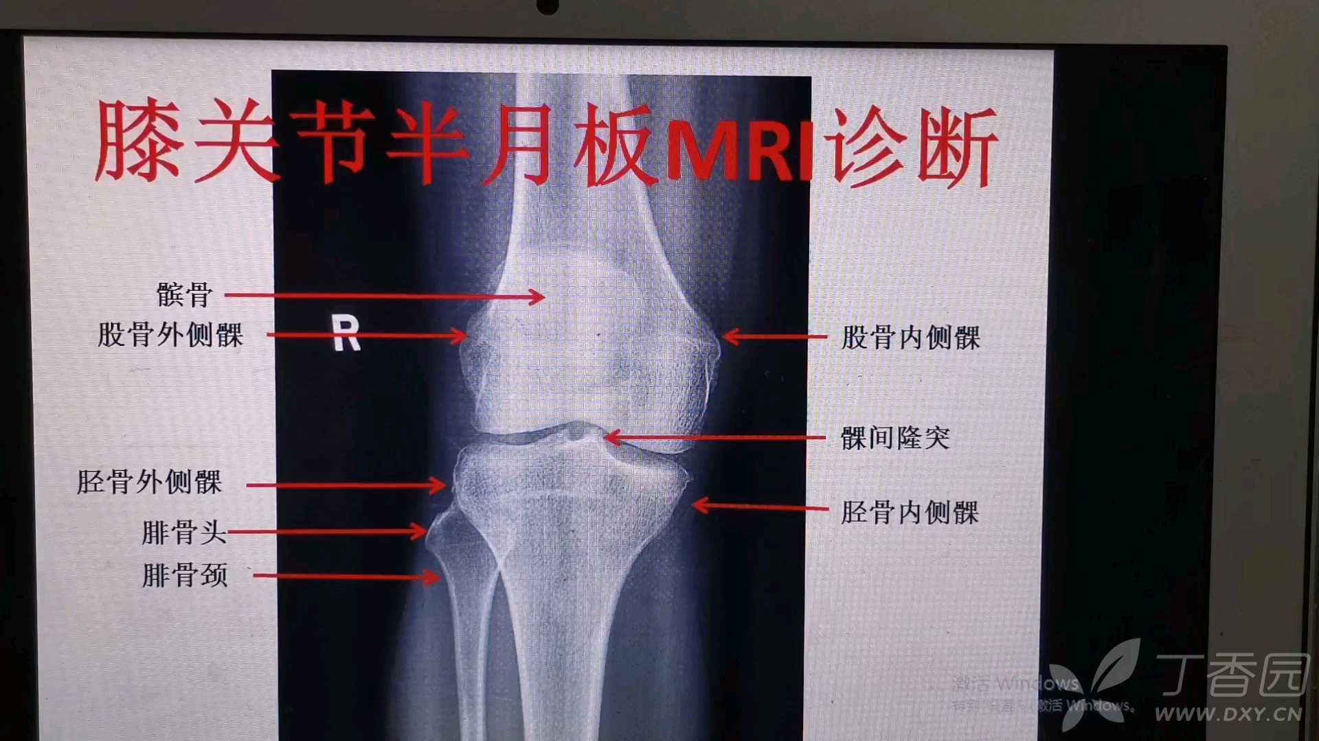 膝盖关节结构图,膝关节解剖结构图高清 - 伤感说说吧