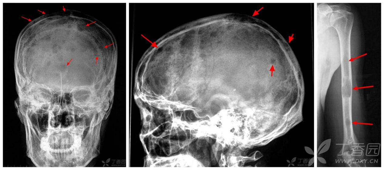 额骨骨瘤ct图片图片