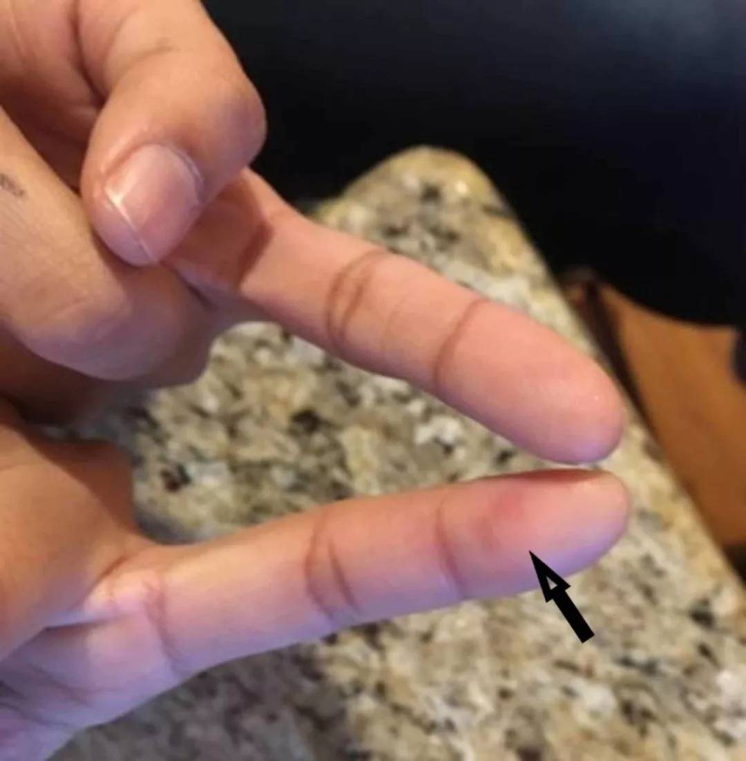 感染性心内膜炎就医记