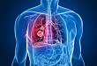 重磅消息！小细胞肺癌新希望——安罗替尼获批用于小细胞肺癌三线及以上治疗