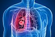 重磅消息！小细胞肺癌新希望——安罗替尼获批用于小细胞肺癌三线及以上治疗