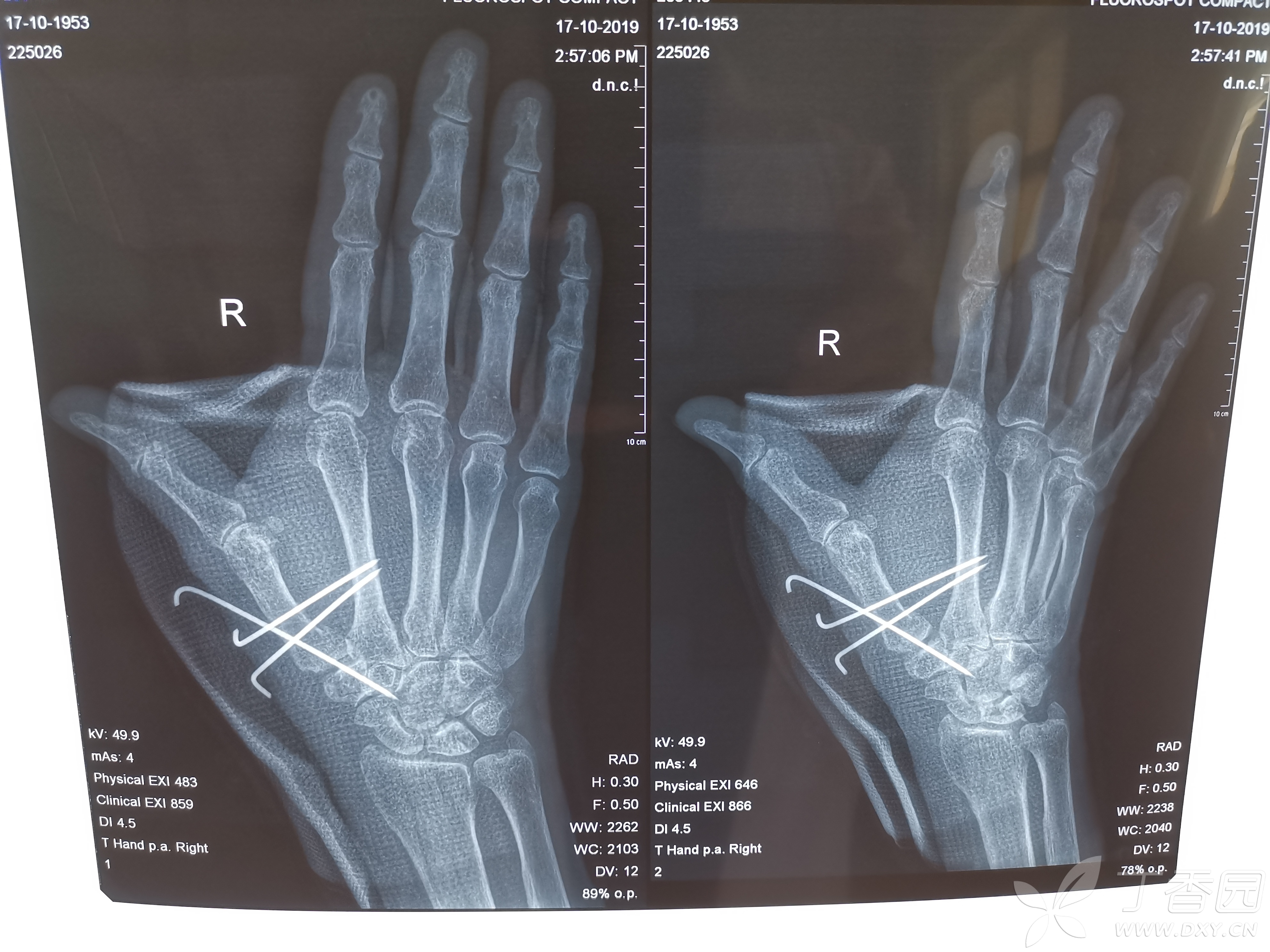 手掌骨折x光图片
