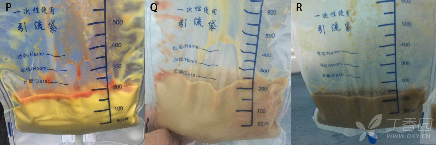 各式各样的腹腔引流液