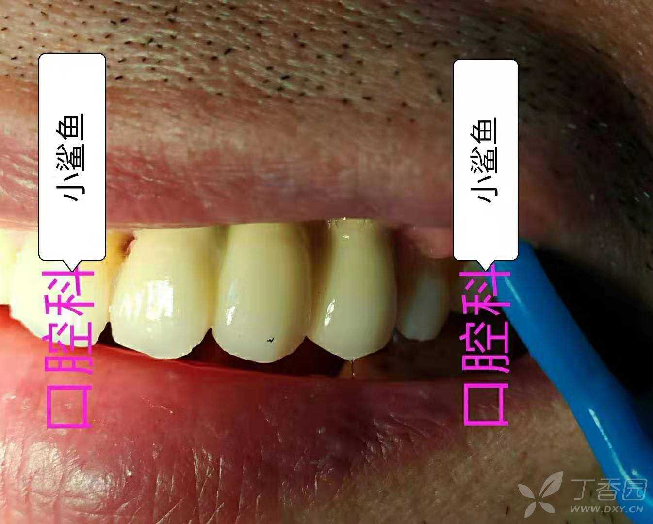 B区即拔即种种植固定桥一例 - 丁香园论坛