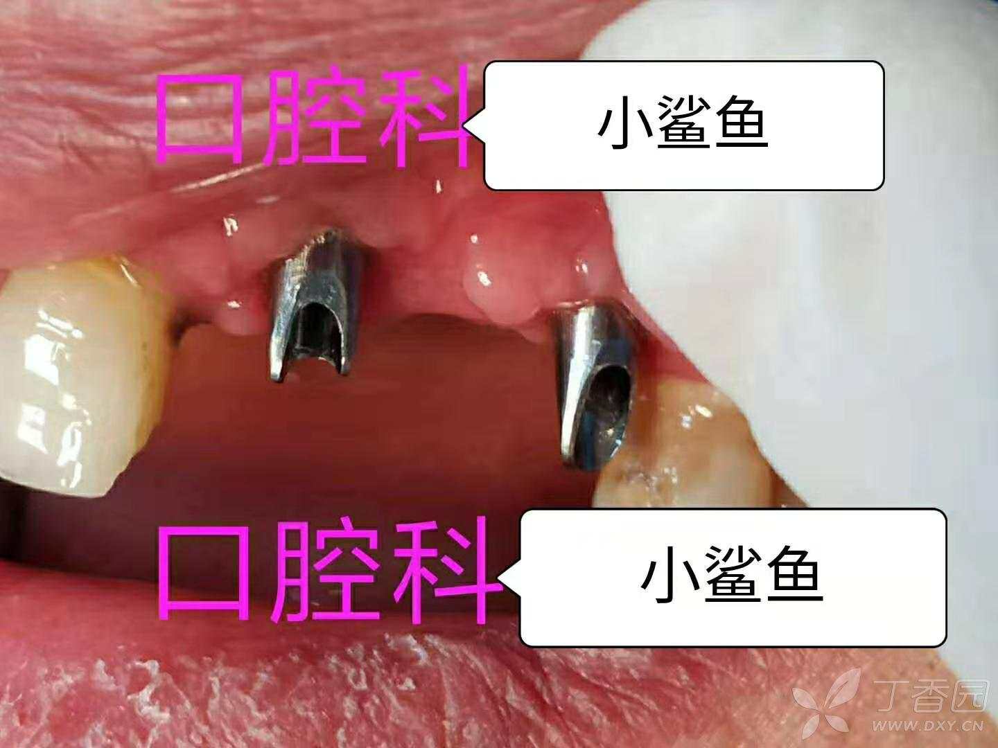 B区即拔即种种植固定桥一例 - 丁香园论坛