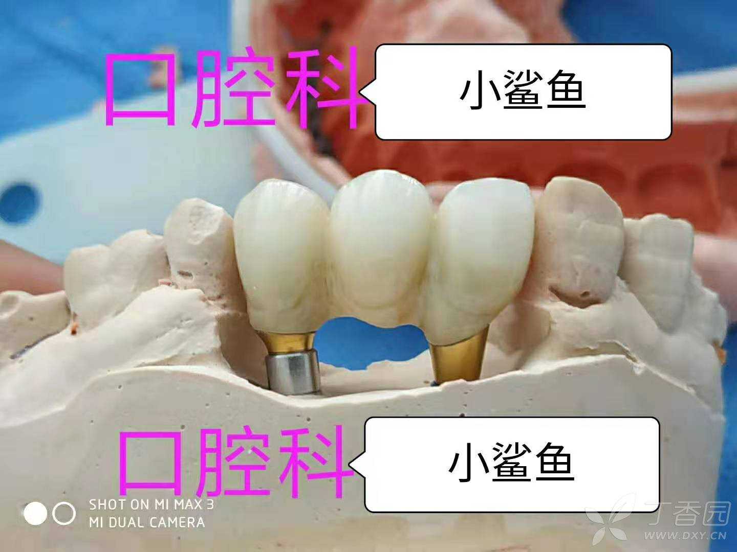 B区即拔即种种植固定桥一例 - 丁香园论坛