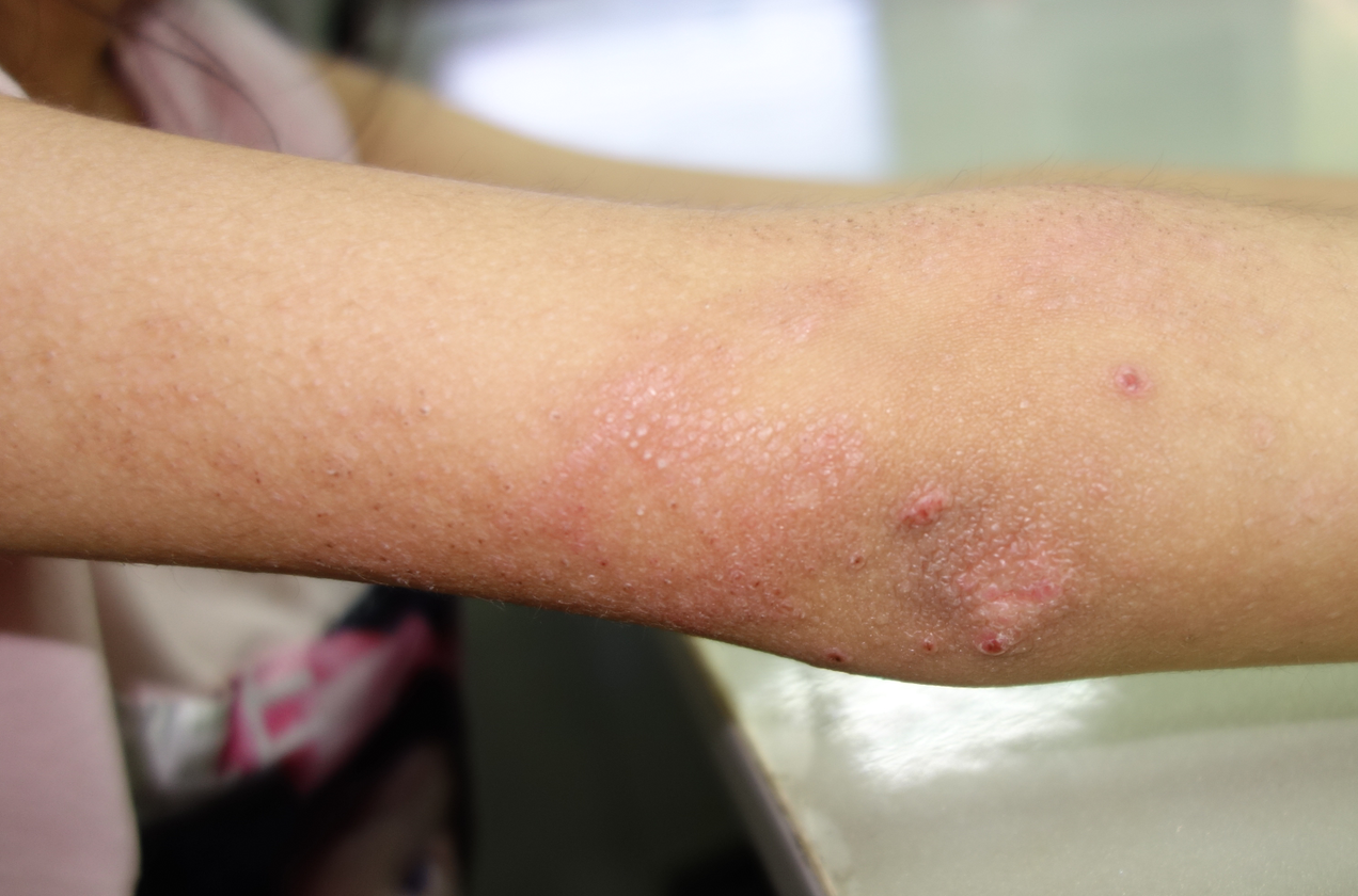 分享一例"疾病特异性"的皮损(已公布答案)