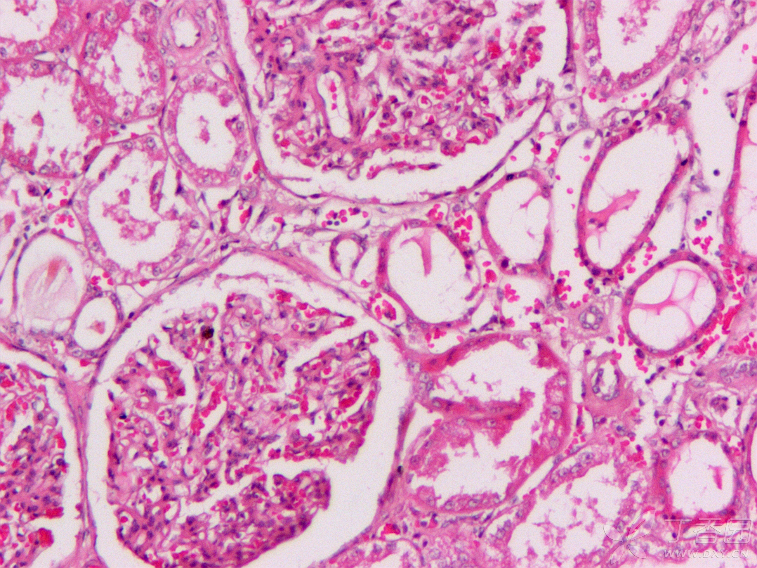 图二三是肾的he,除了肾小球增大,系膜增厚,肾小管扩张,肾小管玻璃样