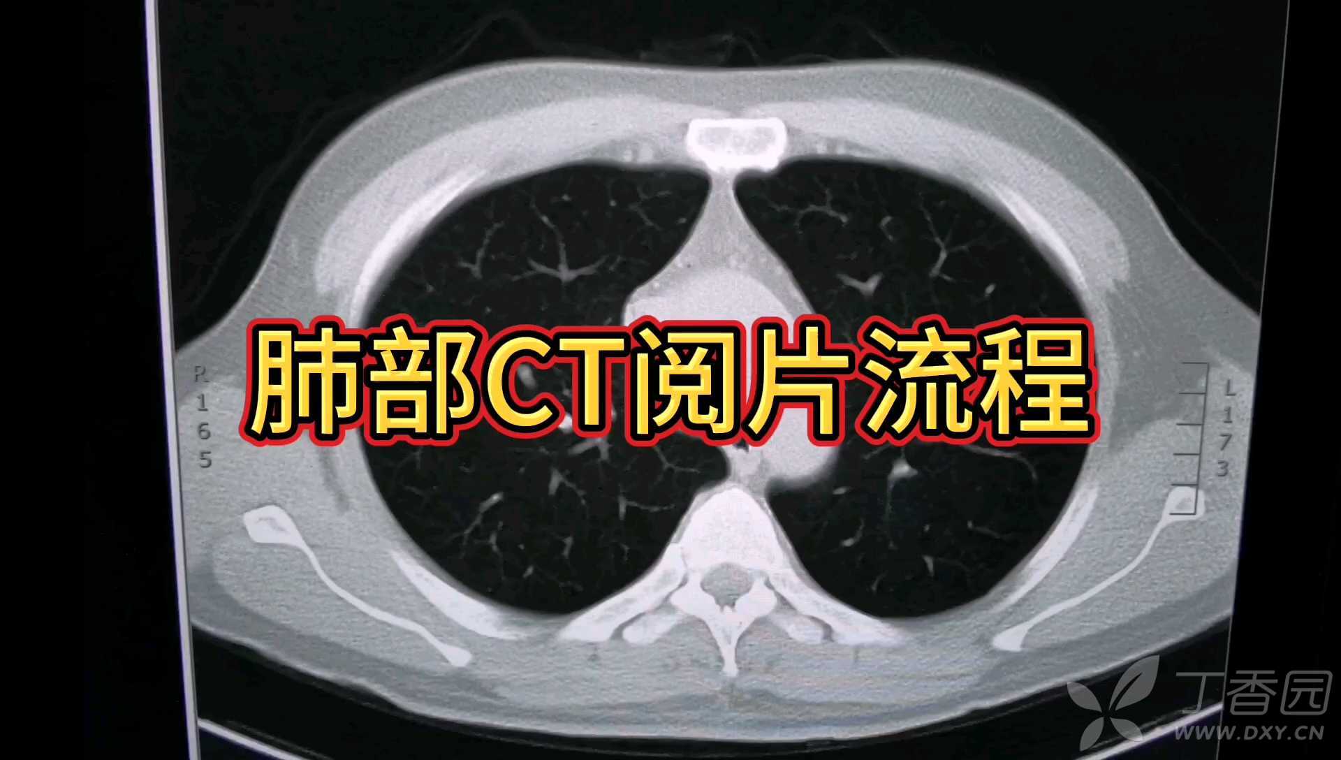 胸部CT包括哪些窗位?各窗位胸部CT大致阅片流程,你知道吗?