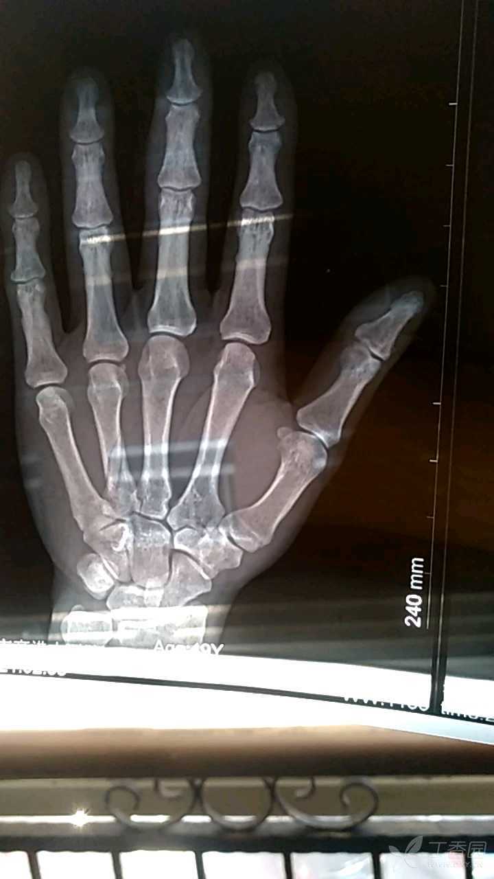 无名指有点骨折,看一下要不要手术治疗