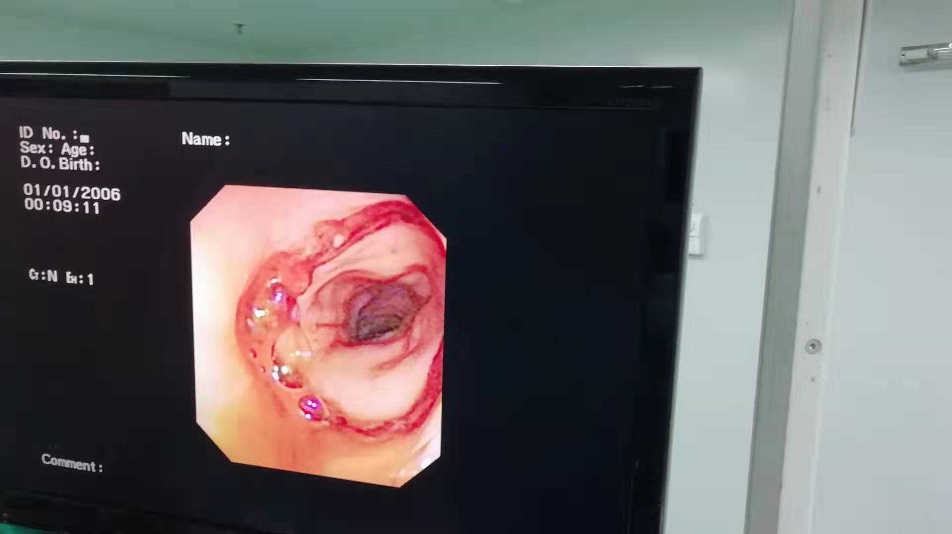 腹腔镜辅助左半结肠切除术后当天,吻合口出血,你会怎么办?