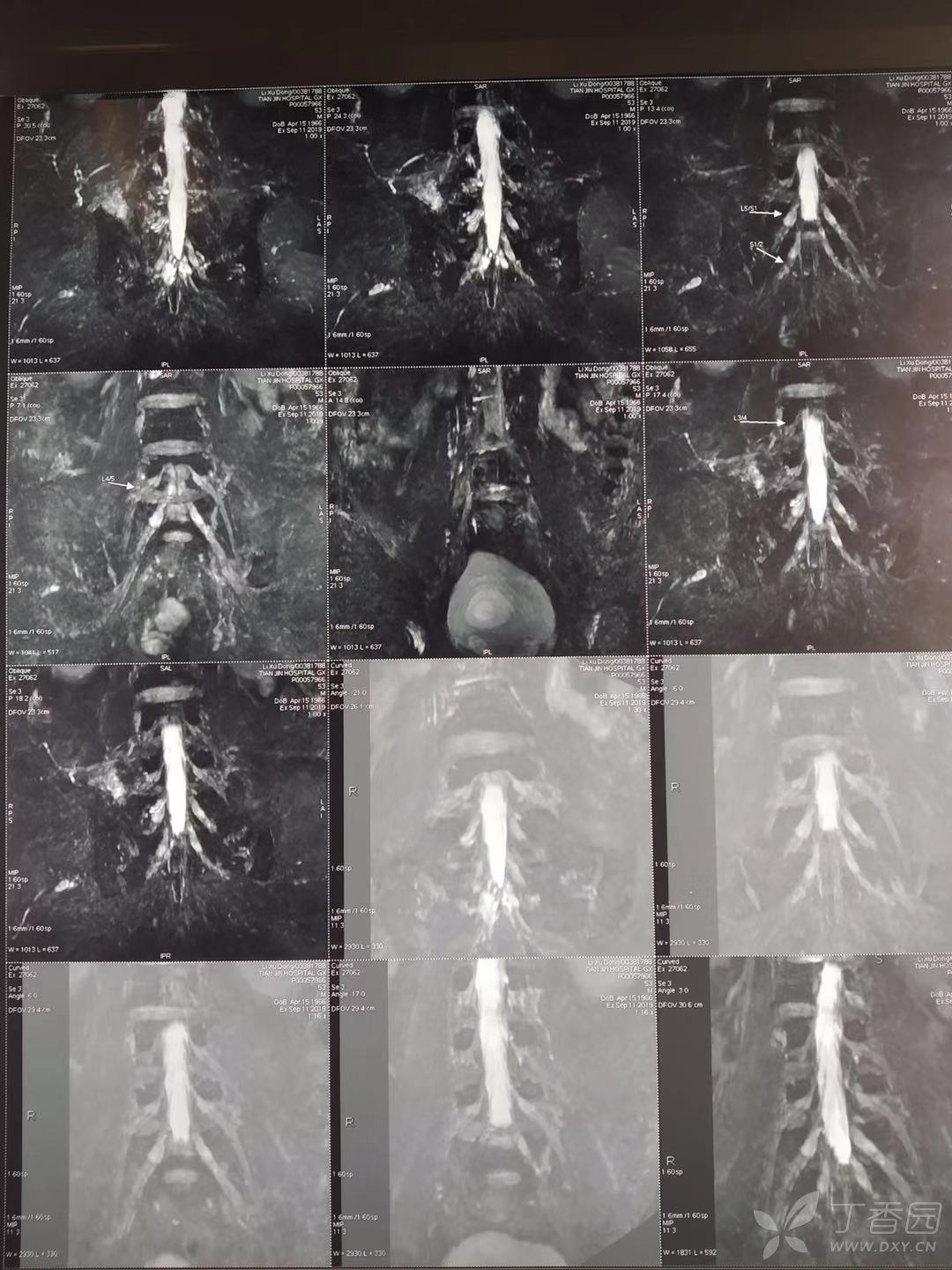 什么原因引起的患者坐骨神经痛?如何治疗可以缓解?