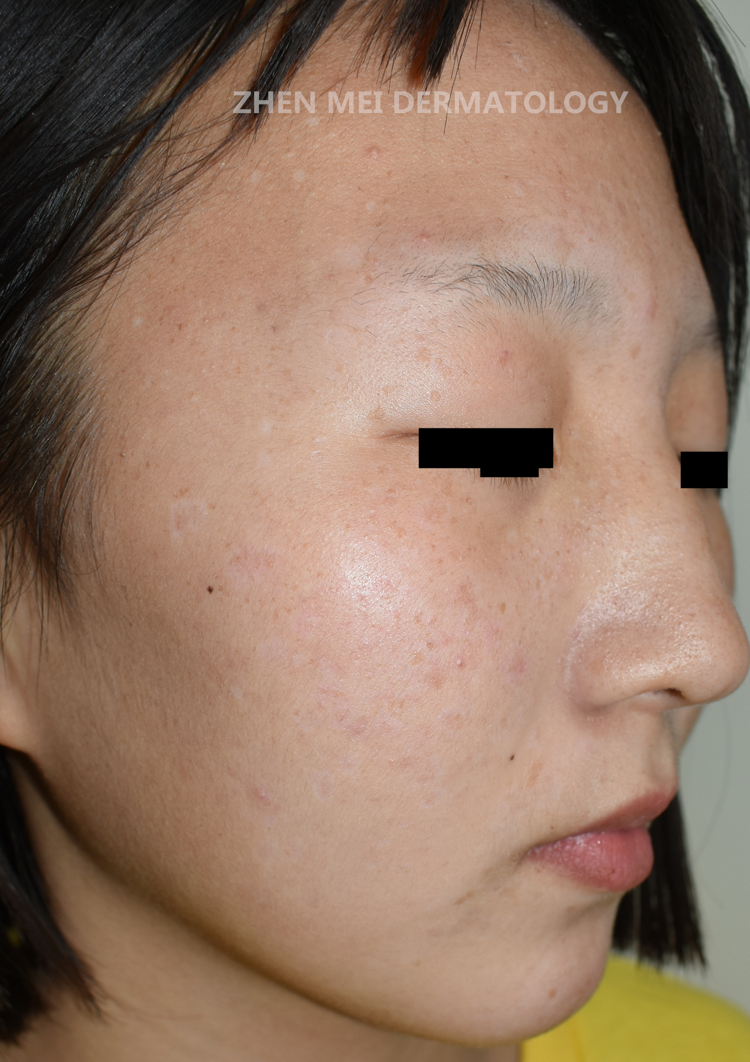 超脉冲二氧化碳激光联合药物治疗面部泛发型扁平疣