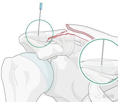 锁骨钩钢板的肩峰下骨溶解现象