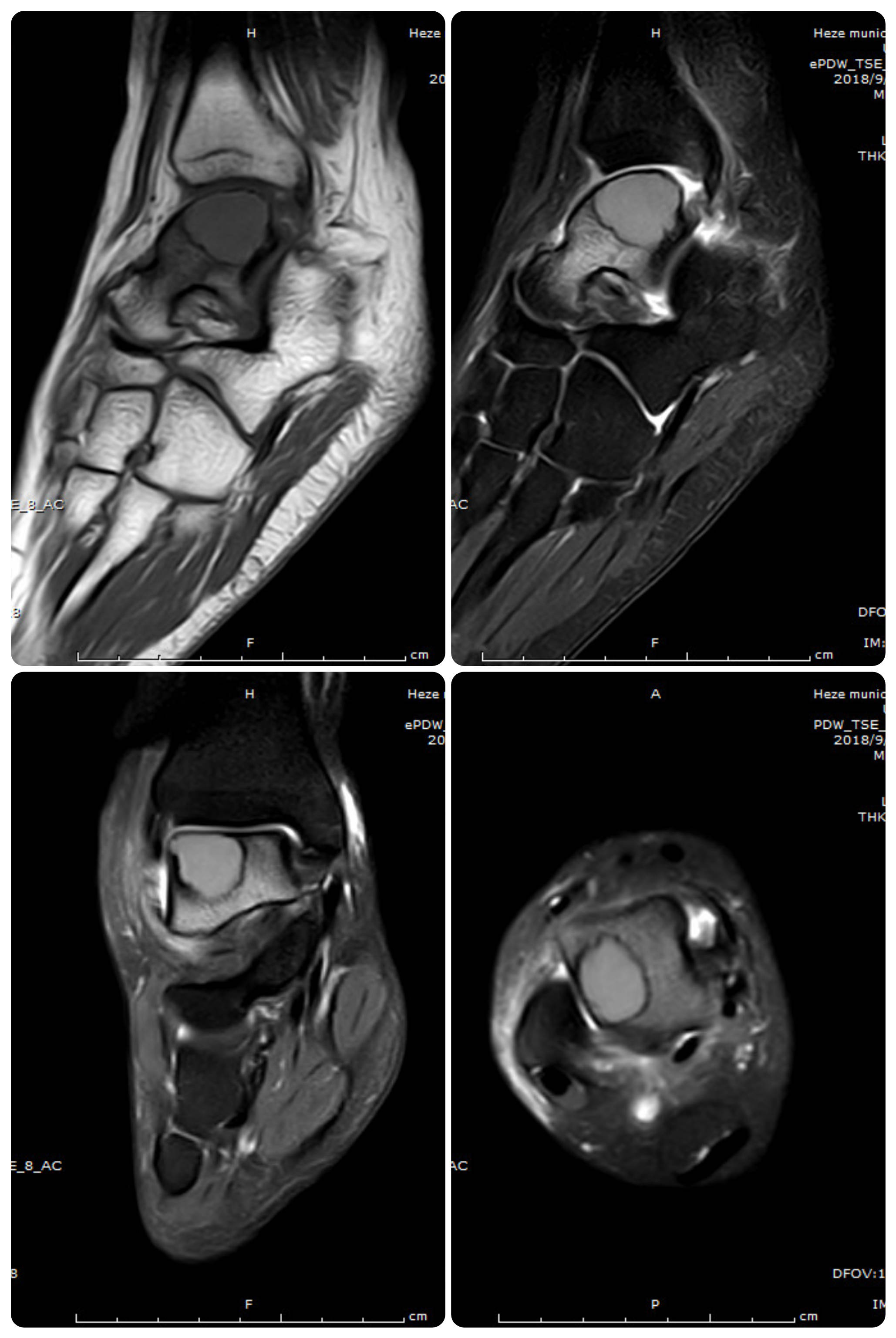 两例骨肿瘤,有结果,可惜资料都不太全.