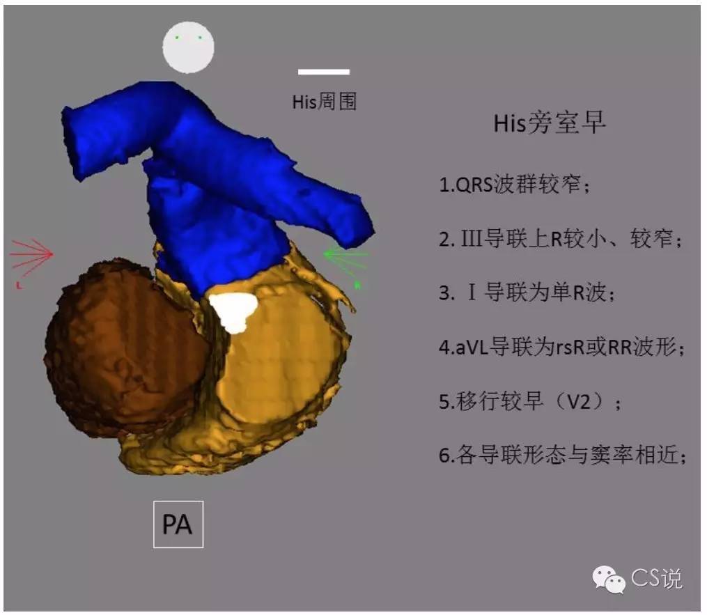 右室流出道室早定位总结(图文并茂) - 丁香园论坛