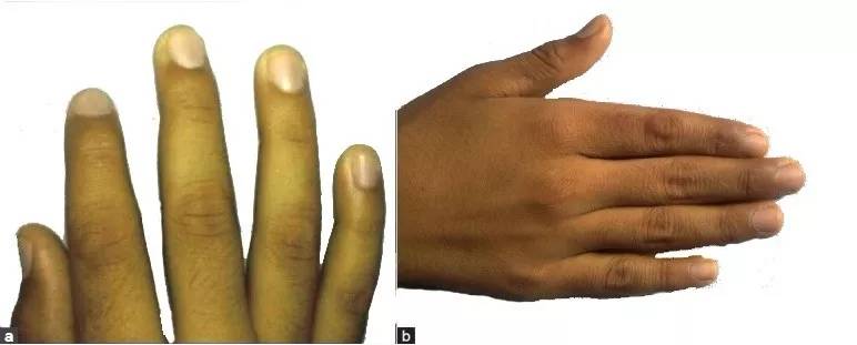 亚甲蓝不适用于这种高铁血红蛋白血症