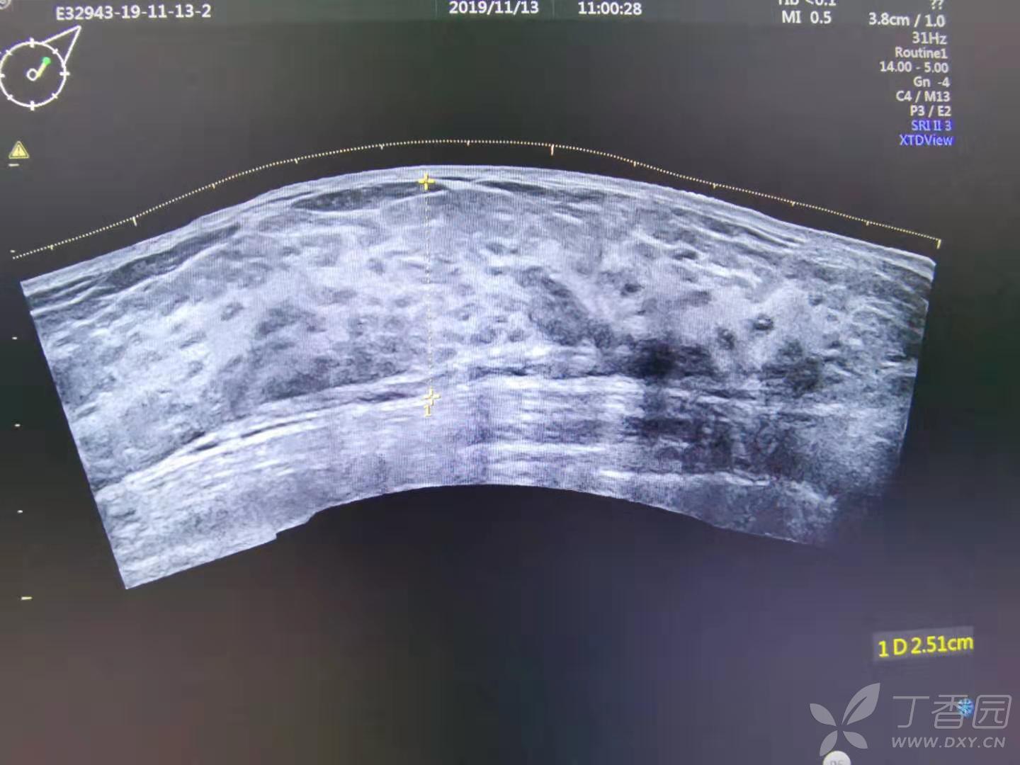 其乳腺全景超声如下