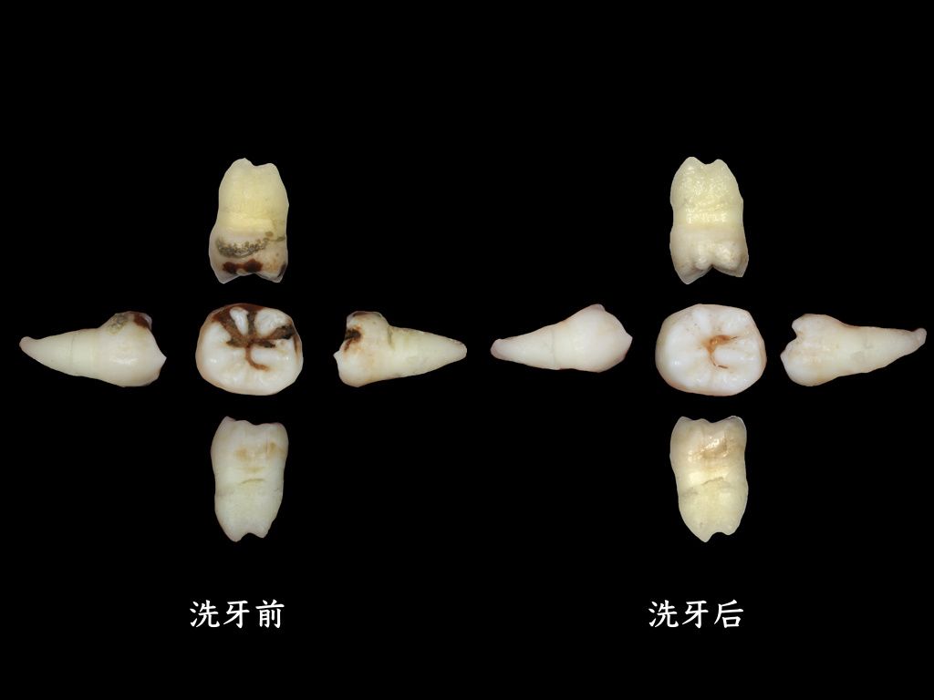 这就是洗完的牙齿,右边的一排「石头」就是从这个牙齿上震落下来的