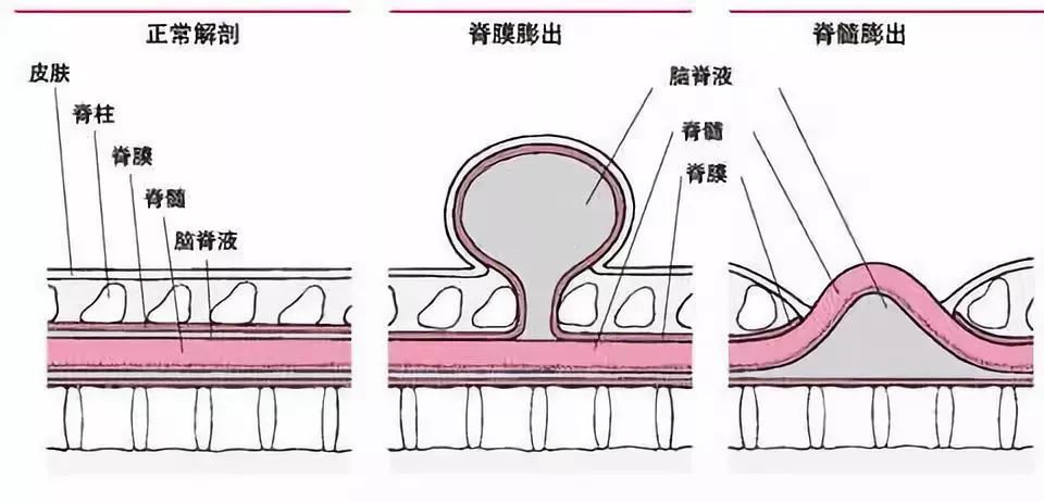 先天性皮毛窦图片