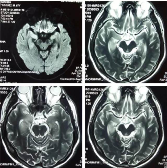 頭顱 mri 顯示:雙側海馬 t2-flair 信號增高